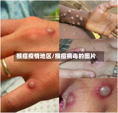 猴痘疫情地区/猴痘病毒的图片
